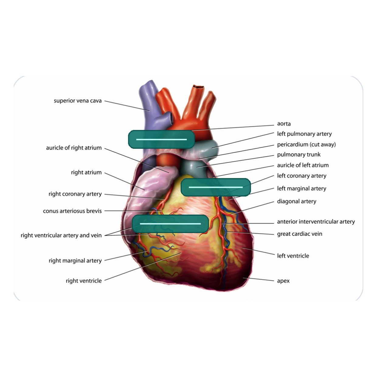 A densely labeled anterior heart diagram with several teal occlusion masks and crossing leader lines.